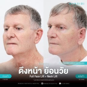 before-after photo deep-plane-facelift
