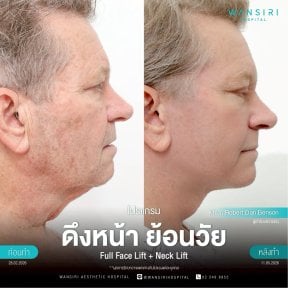 before-after photo deep-plane-facelift