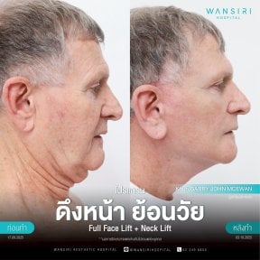 before-after photo deep-plane-facelift