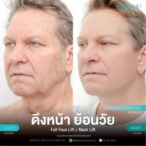 before-after photo deep-plane-facelift