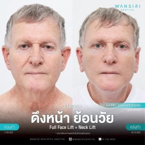 before-after photo deep-plane-facelift