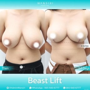 before-after photo deep-plane-facelift