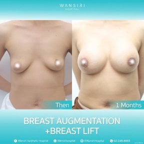 before-after photo deep-plane-facelift