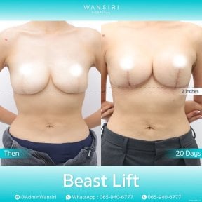 before-after photo deep-plane-facelift