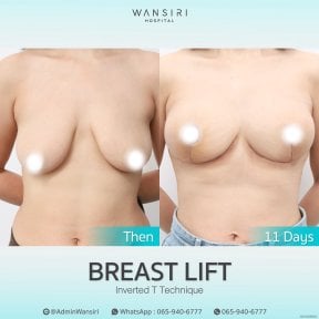 before-after photo deep-plane-facelift