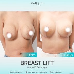 before-after photo deep-plane-facelift
