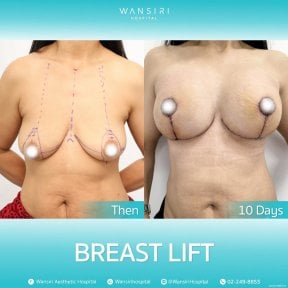 before-after photo deep-plane-facelift