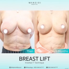 before-after photo deep-plane-facelift