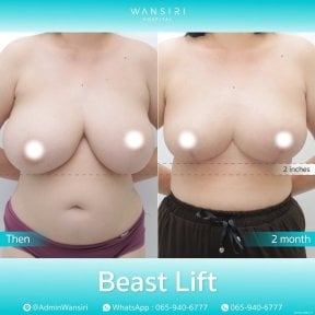 before-after photo deep-plane-facelift