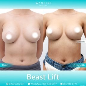 before-after photo deep-plane-facelift