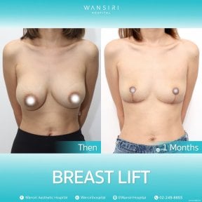 before-after photo deep-plane-facelift
