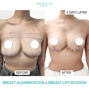 before-after photo deep-plane-facelift