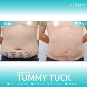 before-after photo vaser-liposuction