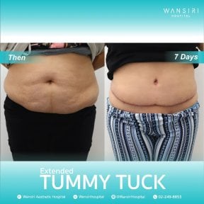 before-after photo vaser-liposuction