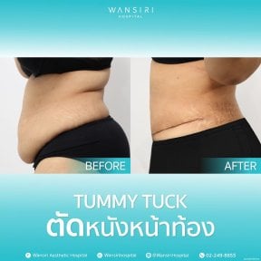before-after photo vaser-liposuction