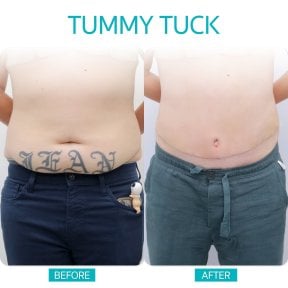 before-after photo vaser-liposuction