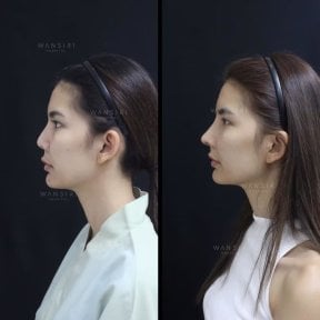 before-after photo abdominoplasty
