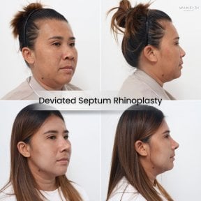 before-after photo abdominoplasty