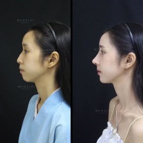 before-after photo abdominoplasty
