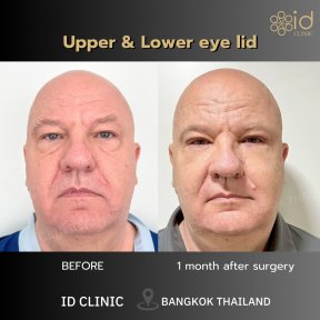 before-after photo lifting-lba