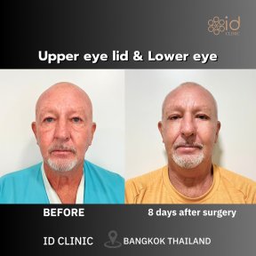 before-after photo lifting-lba