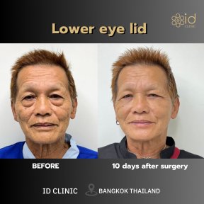 before-after photo lifting-lba