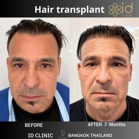before-after photo penis-enlargement