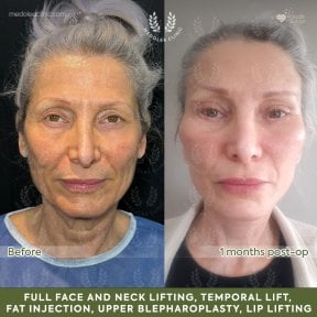 Before and after deep plane facelift results at Dr. Safa Manav Clinic, visible facial rejuvenation