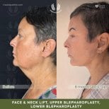 Before and after face and neck lift, blepharoplasty results at Medolea Clinic, visible lift