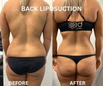 before-after photo liposuction
