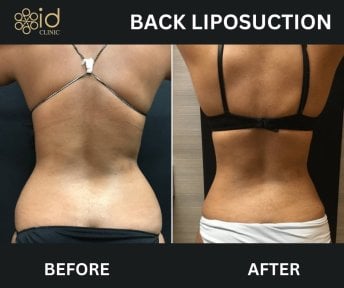 before-after photo liposuction