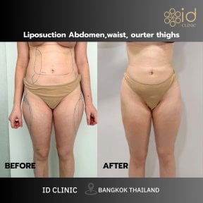 before-after photo liposuction