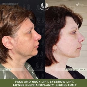 Before and after deep plane facelift results at Dr. Safa Manav Clinic, visible facial rejuvenation