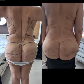 before-after photo thigh-lift