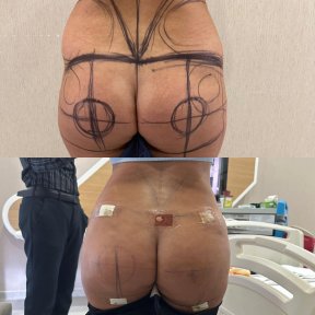 before-after photo thigh-lift