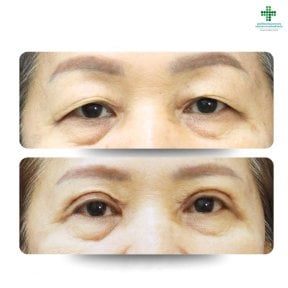 before-after photo blepharoplasty-eyelid