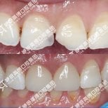 Resultado antes y después de carillas Emax en Wuhan Yiya Simei Dental Hospital, sonrisa