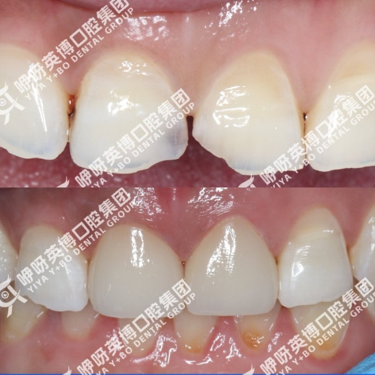 قبل وبعد الفينير في عيادة Shanghai Y+bo Dental Clinic – نتائج استعادة الابتسامة