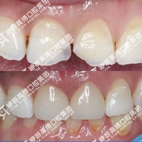 before-after photo installation-of-a-veneer