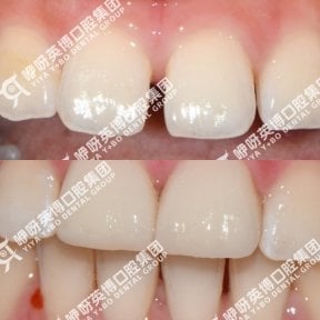 before-after photo installation-of-a-veneer