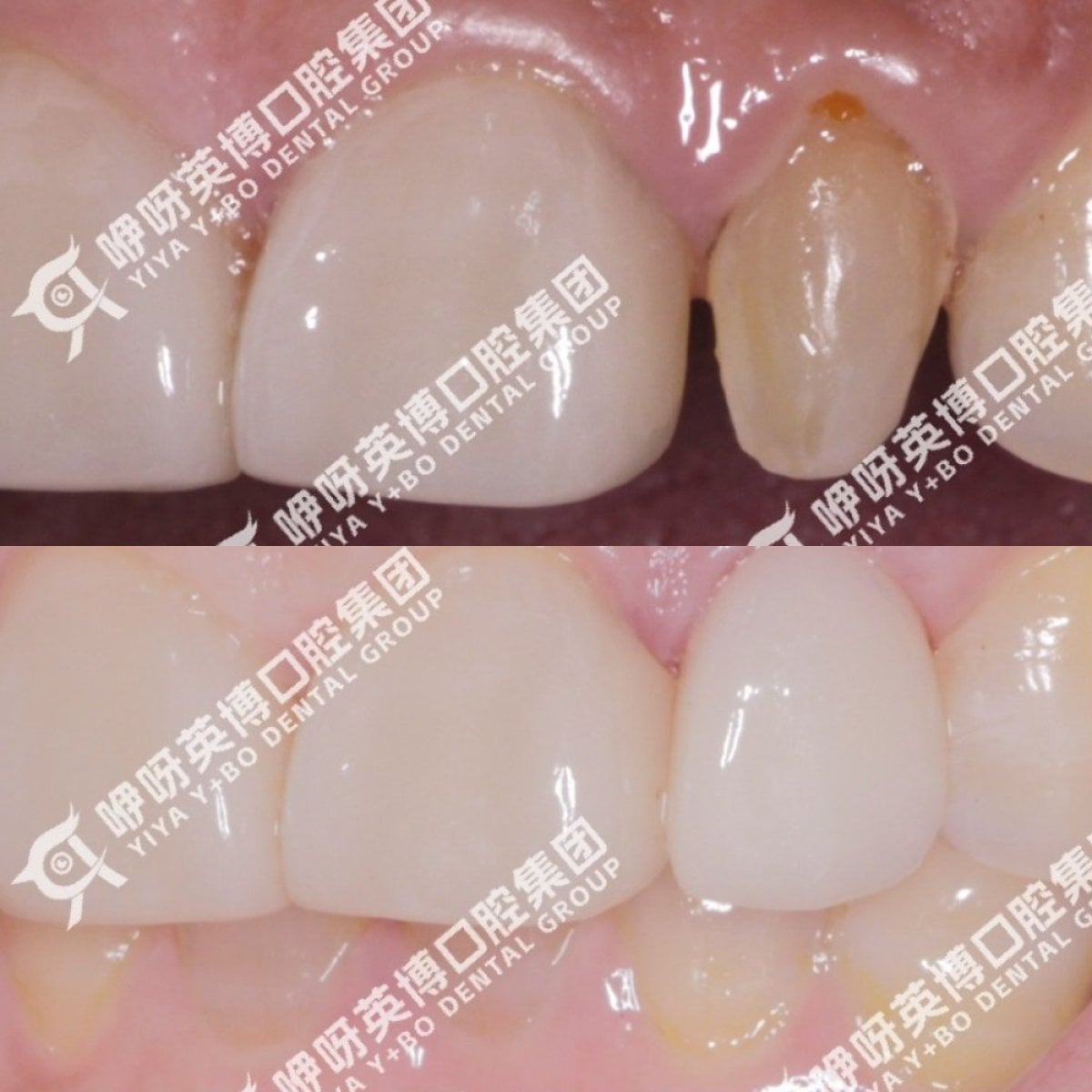 Resultado antes y después de carillas en Shanghai Y+bo Dental Clinic, mejora de dientes frontales