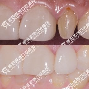 before-after photo installation-of-a-veneer