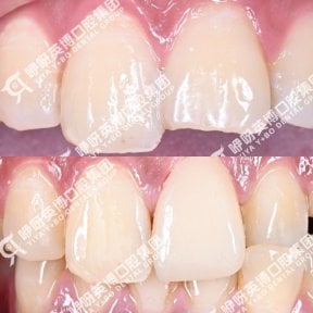 before-after photo installation-of-a-veneer