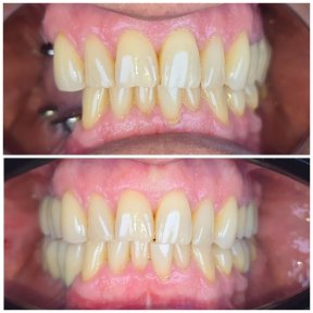Before and after All-on-4 dental implants result – improved smile and teeth alignment