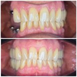 Before and after All-on-4 dental implants result – improved smile and teeth alignment