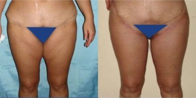 before-after photo operacia-pri-ginekomastii