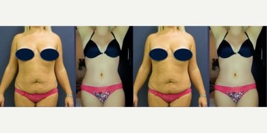before-after photo operacia-pri-ginekomastii