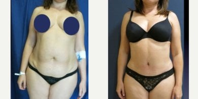 before-after photo operacia-pri-ginekomastii