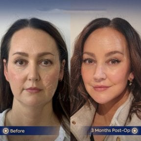 before-after photo tightening-of-facial-skin-facelift