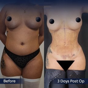before-after photo 360-liposuction